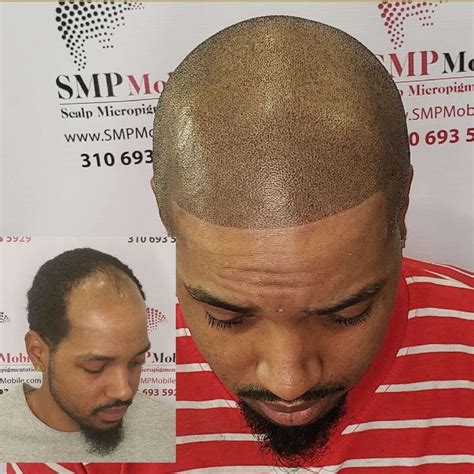 Everything You Need to Know About Scalp Micropigmentation.